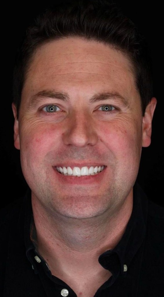 After Hollywood Smile or Antalya dental implants — placeholder