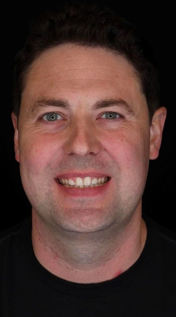 Before Antalya dental treatment — placeholder