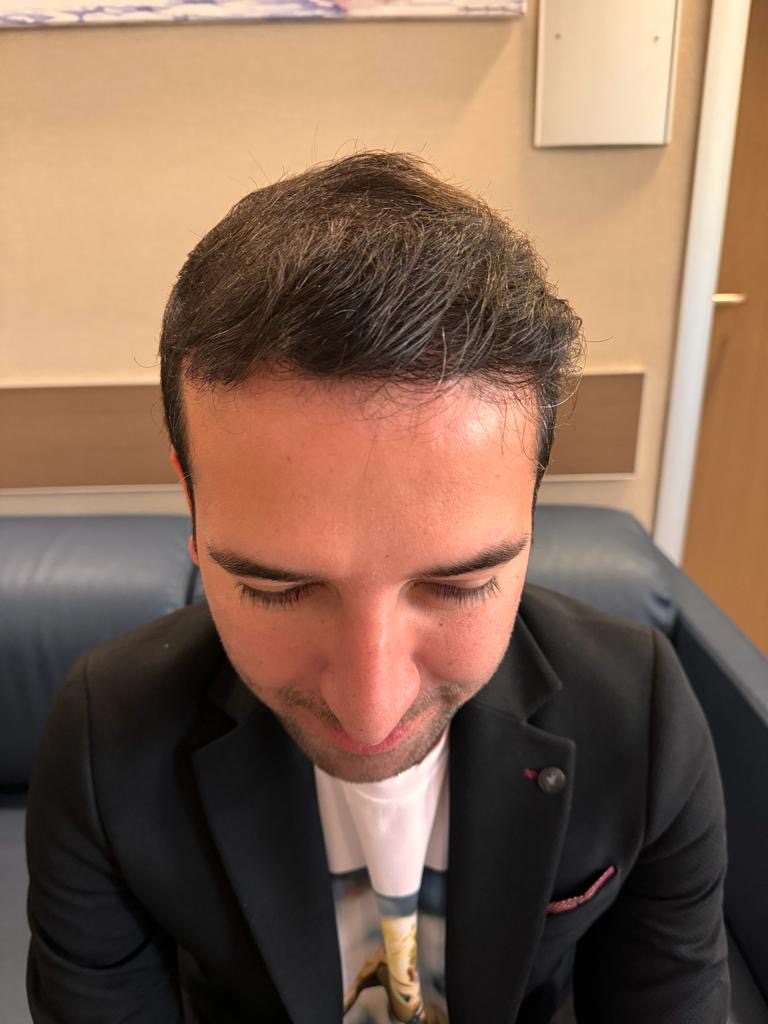 After hair transplant — placeholder image for Antalya hair transplant results