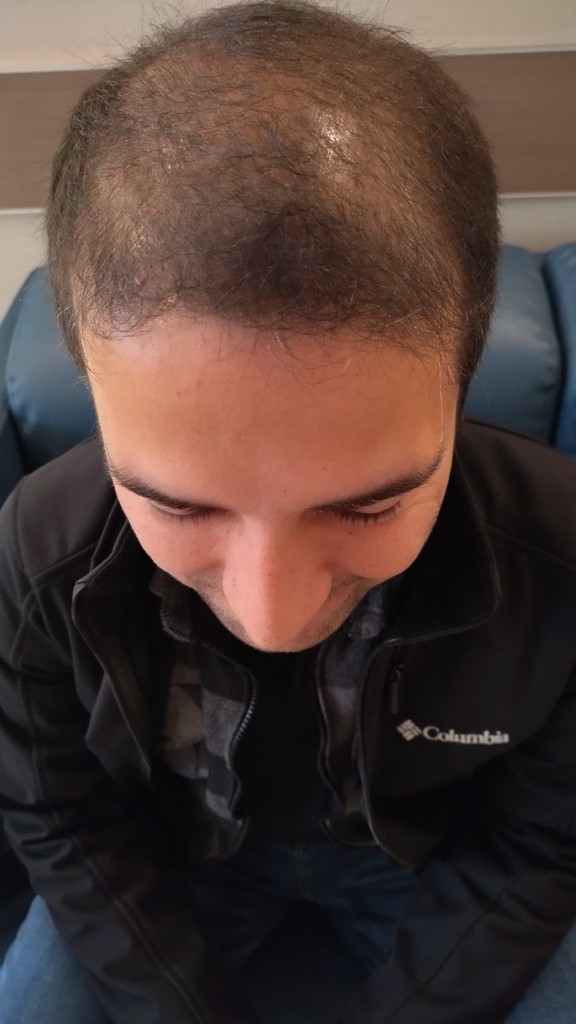 Before hair transplant — placeholder image